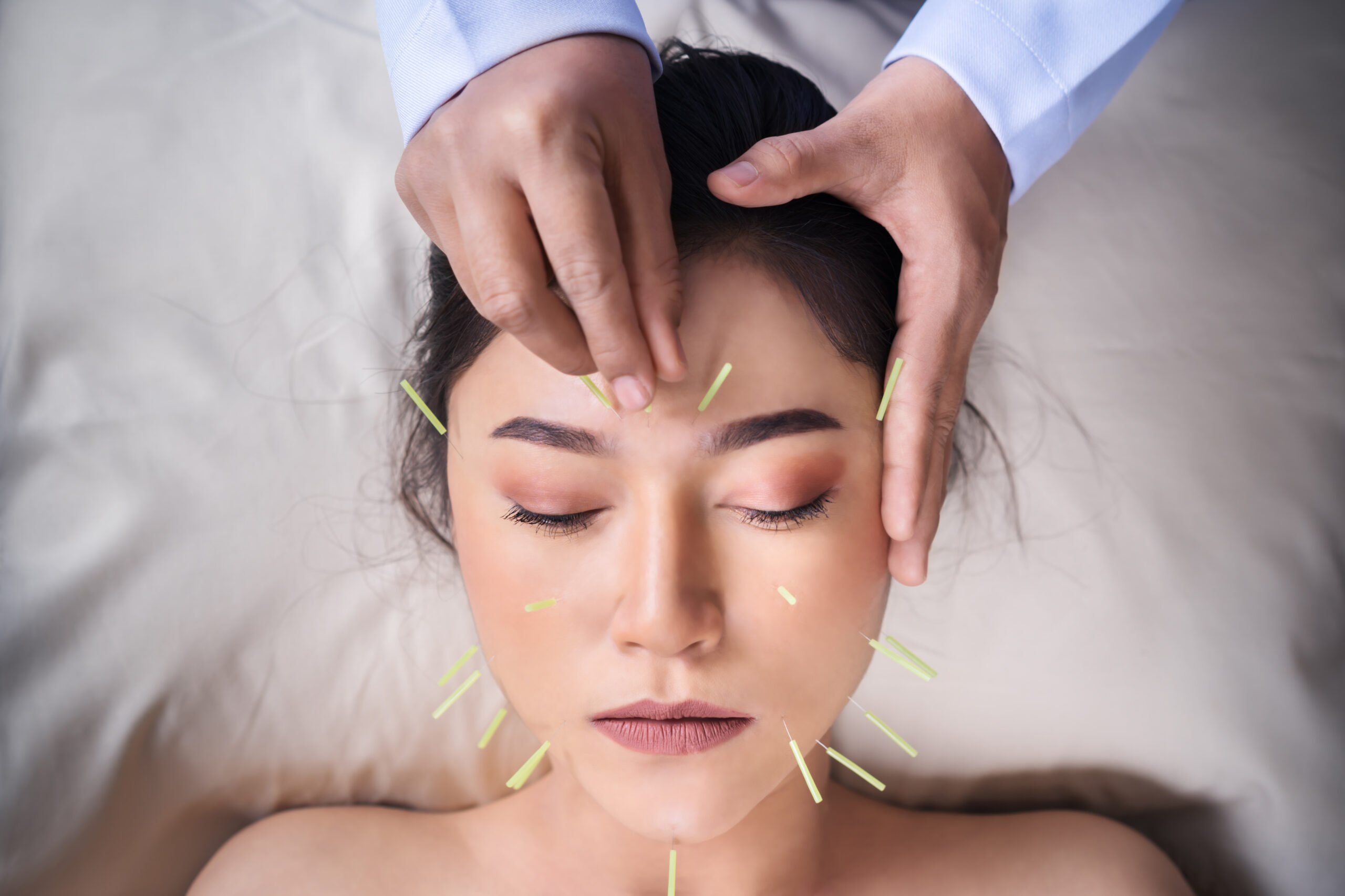 young woman undergoing acupuncture treatment on face